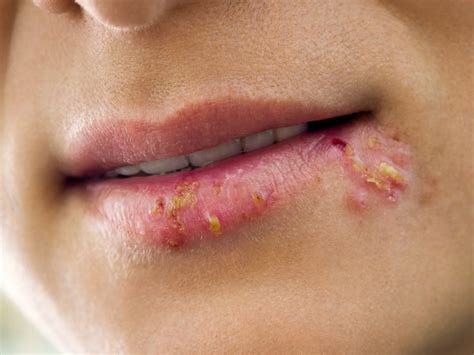 Lūpų pūslelinė (herpes simplex)