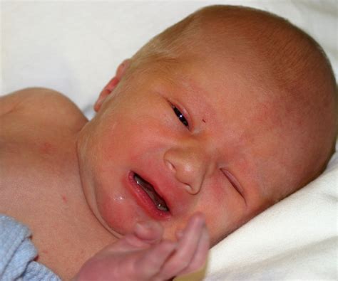 Naujagimio gelta: fiziologinė ir patologinė