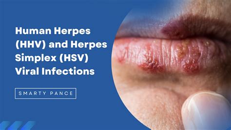 Herpes Simplex virusų perdavimo keliai