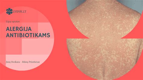 Alerginės reakcijos į antibiotikus simptomai