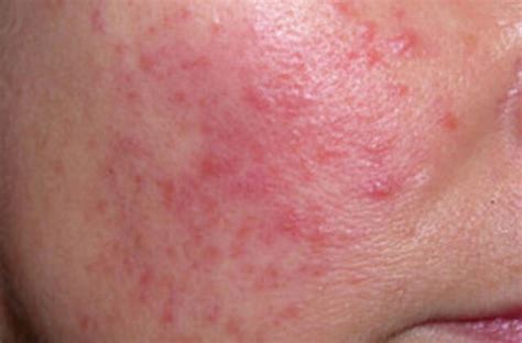 Rožinės paveiktos odos simptomai: paraudimas, bėrimai, išsiplėtę kapiliarai