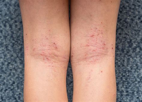 Atopinis dermatitas. Veiksniai, sukeliantys atopinį dermatitą