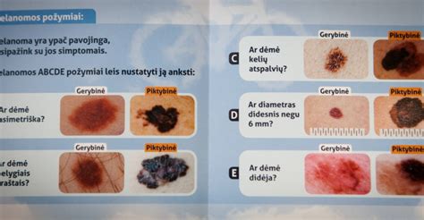Papilomos, apgamai ir karpos: skirtumai