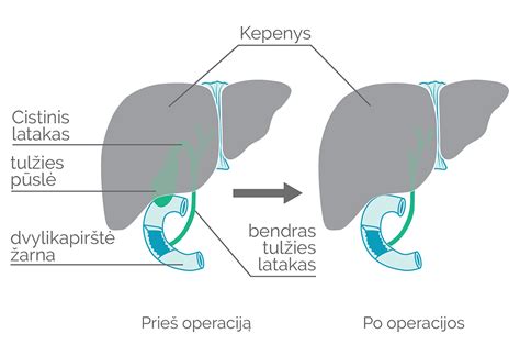 Schema: blužnies šalinimo operacija