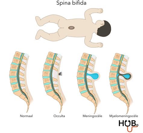 Spina Bifida: stuburo defektas