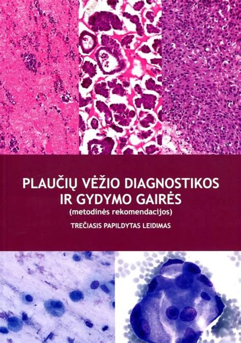 Plaučių vėžio gydymo metodų palyginimas