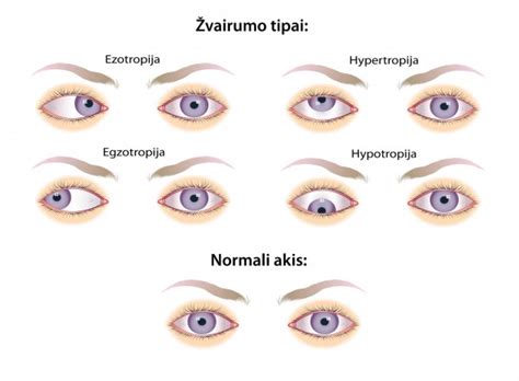 Žvairumo tipai ir akių padėtis