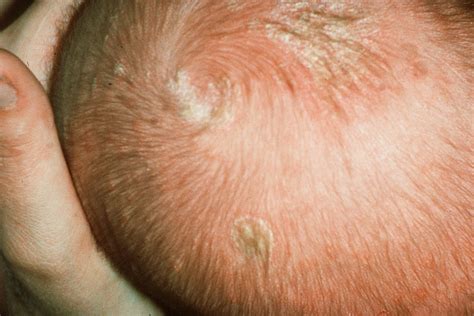 Naujagimio galvos hematoma po vakuuminės ekstrakcijos