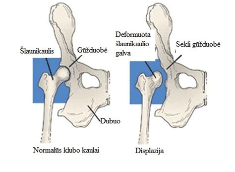 kūdikio klubų sąnario schema