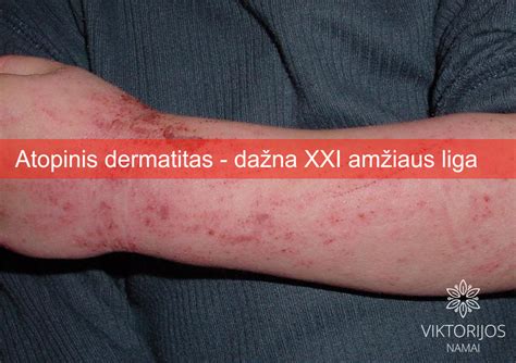 Atopinis dermatitas ir virškinimo sutrikimai