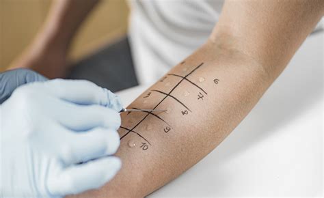 Alergijos tyrimo metodai: odos dūrio testas