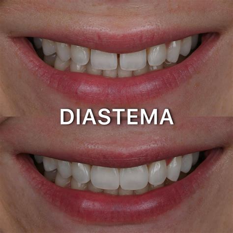 Lūpos pasaitėlis ir diastema