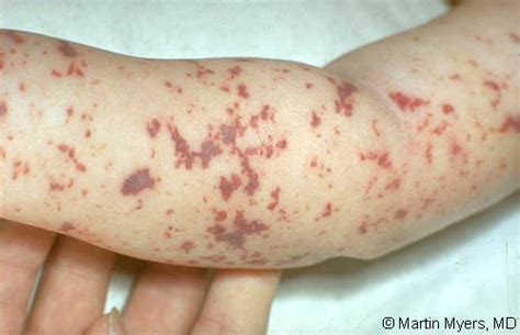 Meningokokinės infekcijos bėrimas