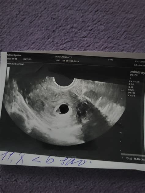 vaisiaus raida 35 savaitės