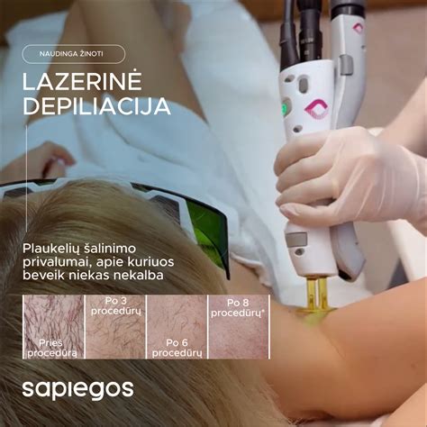 Lazerinio apgamų šalinimo schema