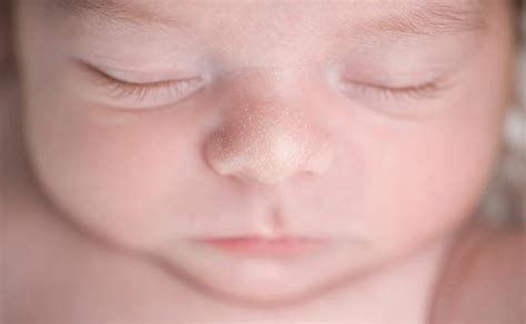 Balti spuogeliai ant kūdikio nosies