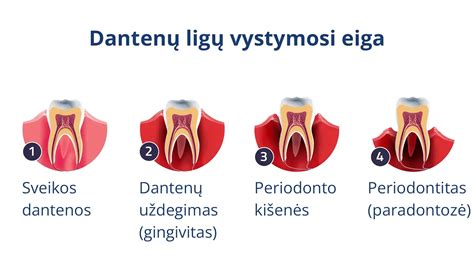 Nėštumo gingivito simptomai