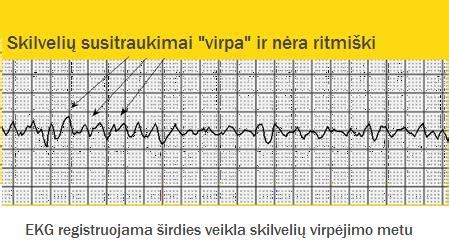 Vaisiaus širdies ritmo grafikas