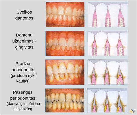 Periodonto ligų poveikis nėštumui