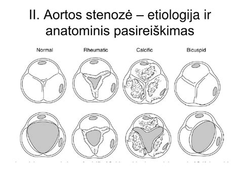 Aortos stenozės simptomų infografika