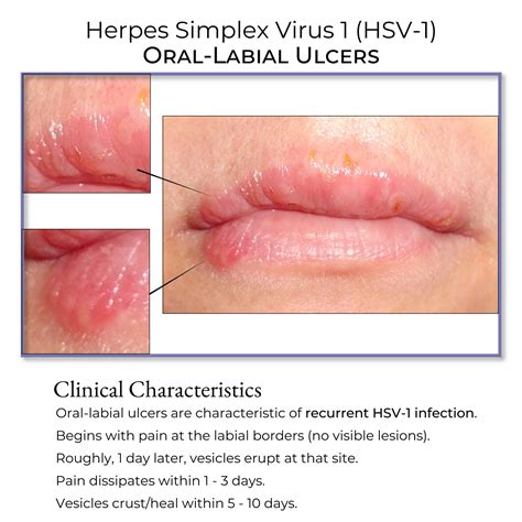 Herpes simplex viruso nuotrauka
