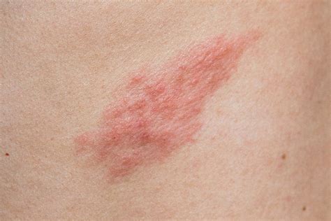 kirkšnies srities odos dirginimas ir bėrimas