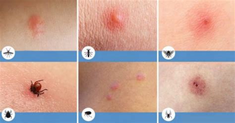 palyginamoji vabzdžių įkandimų lentelė