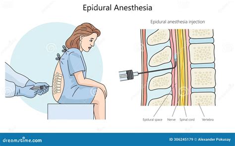 schema of epidural anesthesia