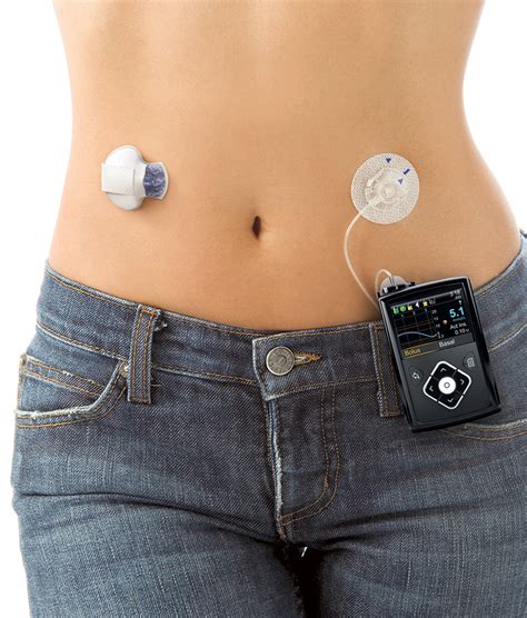 besilaukianti moteris su insulino pompa