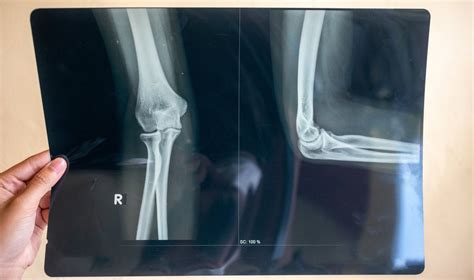 Alkūnės rentgeno nuotrauka