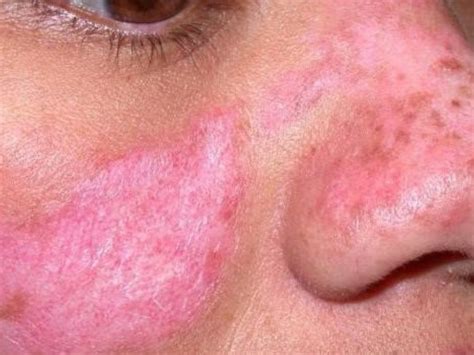 Saulės alergijos bėrimas